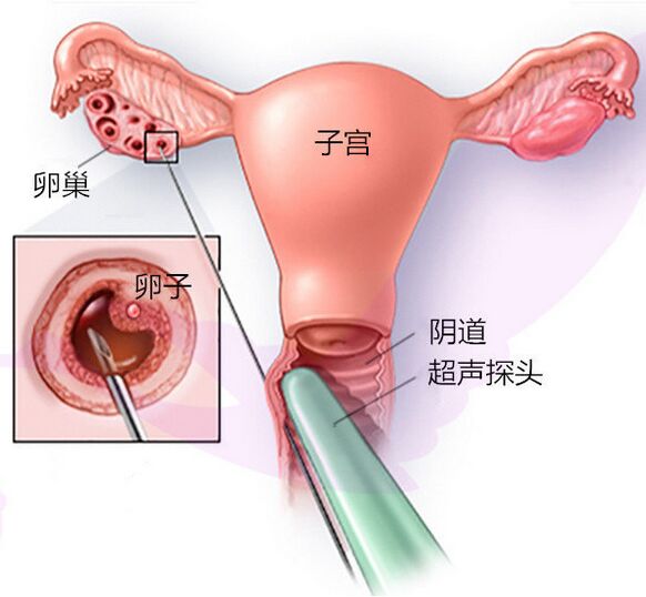 供卵二代代怀试管前期调理备孕,在饮食方面该注意哪些