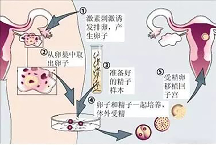异常受精的0pn囊胚可以正常移植吗